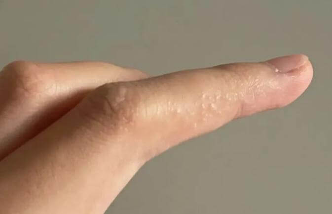 正确识别汗疱疹