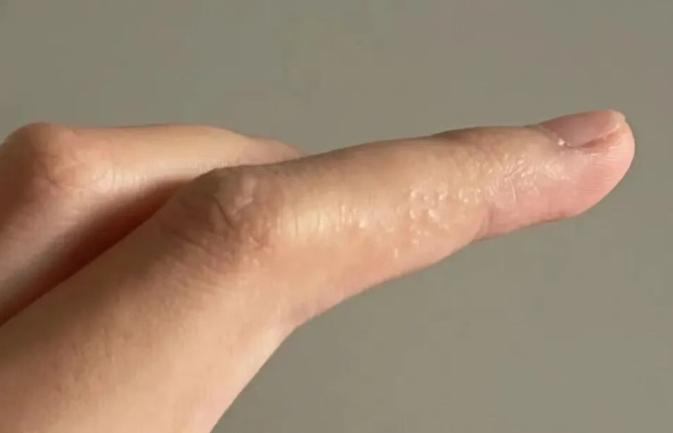 这种夏天手上爱长的小水疱 到底是什么？